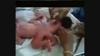 تولد کودک عجیب در هند