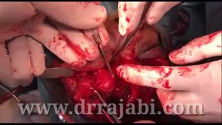 تومور بسیار بزرگ اربیت با گسترش به پیشانی