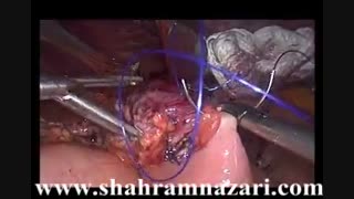 مینی بای پاس معده در درمان چاقی