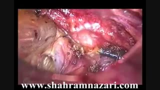 ترمیم لاپاروسکوپی هرنی عودکرده محل برش کیسه صفرا