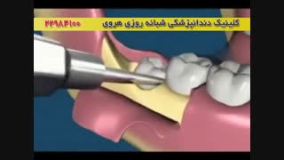 جراحی دندان عقل نهفته