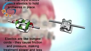 سیستم معمول ارتودنسی و دیمون | دکتر مسعود داوودیان