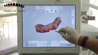 توضیحات در مورد دستگاه دیجیتال اسکنر داخل دهانی 3Shape
