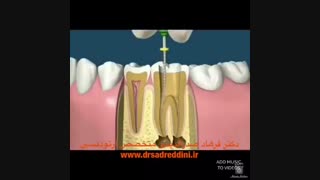 ارتودنسی دندان عصب کشی شده