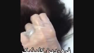 مزوتراپی ریزش مو