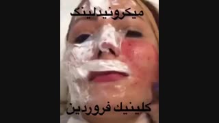میکرونیدلینگ