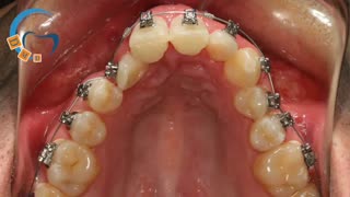 درمان تنگی فک بالا با ارتودنسی دیمون | دکتر مسعود داوودیان