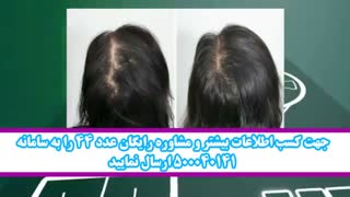 درمان قطعی ریزش مو با محصولی کاملا متفاوت و گیاهی