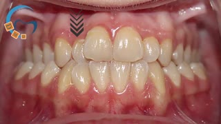 ارتودنسی عقب بودن فک بالا | دکتر مسعود داوودیان