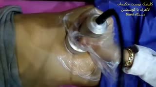 لاغری با کویتیشن شکم