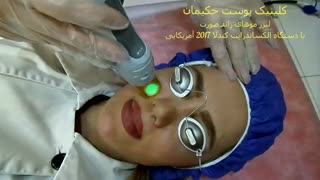 لیزر موهای زائد کاشت مو