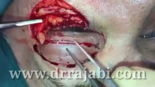 برداشتن کامل پلک بعلت تومور بدخیم و بازسازی مجدد