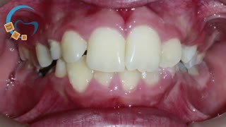 ارتودنسی عقب بودن فک پایین | دکتر مسعود داوودیان