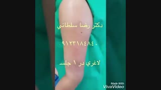 لیپوماتیک بازوها