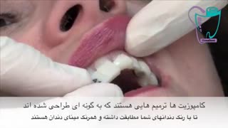 ترمیم کامپوزیت | سیمادنت