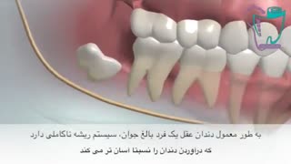 کشیدن دندان عقل نهفته | سیمادنت