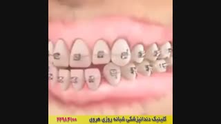 درمان جلو بودن فک در افراد