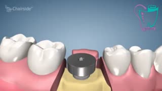 درمان ایمپلنت یک مرحله ای | سیمادنت