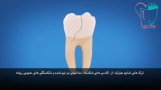 دندان شکسته و درمان آن | سیمادنت