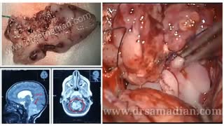 جراحی تومور مغز در کودک 2 ساله