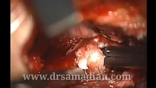 عمل جراحی دیسکتومی در خانم 26 ساله