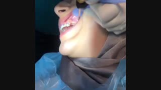 نحوه جایگزاری مینی اسکرو