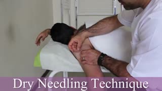 سوزنکاری خشک شانه، فیزیوتراپیست صادق زراعتکار