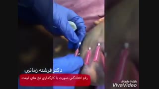 لیفت صورت با نخ های لیفت یا PDO