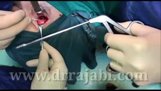 تومور وسیع کاسه چشم ،استخوان اسفنوئید با گسترش به مغز