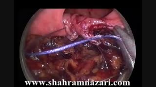 جراحی آندوسکوپیک با رکتوسکوپ مخصوصTEO