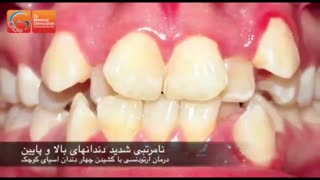 کشیدن دندان برای ارتودنسی | دکتر مسعود داوودیان