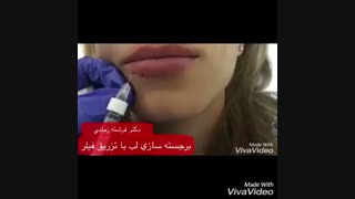 تزریق فیلر جهت برجسته سازی و اصلاح لب