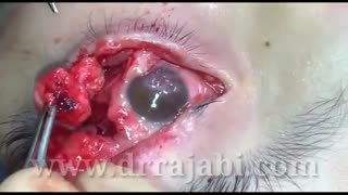 بازسازی پلک بالا و پایین و برداشتن تومور در کودکی