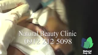 کاشت ابرو طبیعی در کلینیک نچرال بیوتی