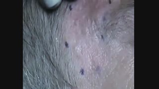 فیلم سوم.ماکرودرم ابراژن. درمان اسکار ها.دکتر مقیمی