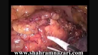 رزکسیون لاپاروسکوپیک پانکراس بلحاظ تومور(انسولینوما)