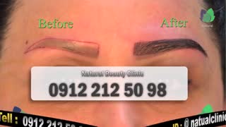 نمونه کار کاشت ابرو-قبل و بعد از کاشت-نچرال بیوتی