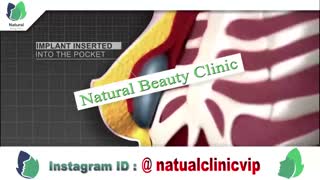 پروتز سینه چگونه انجام میشود