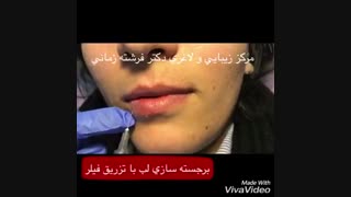 تزریق نیم سی سی ژل لب جهت برجسته سازی