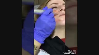 مزوتراپی و میکرونیدلینگ جهت جوانسازی پوست