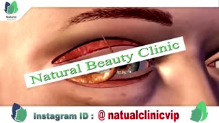 جراحی پلک - نچرال بیوتی