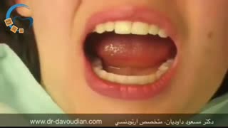 مراحل دیباند یا کندن براکت های ارتودنسی | دکتر داوودیان