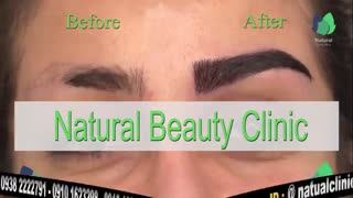 نمونه کار کاشت ابرو- قبل و بعد از کاشت!- نچرال بیوتی