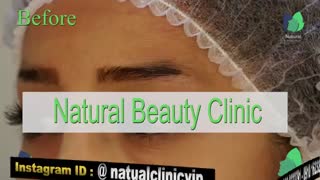 نمونه کار کاشت ابرو- قبل و بعد از کاشت!- نچرال بیوتی