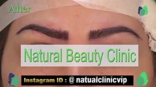 نمونه کار کاشت ابرو- قبل و بعد از کاشت!- نچرال بیوتی