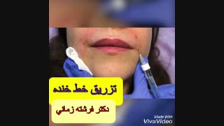 رفع خط خنده با تزریق ژل هیالورونیک اسید