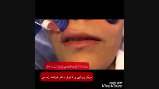 برجسته سازی لب با تزریق فیلر