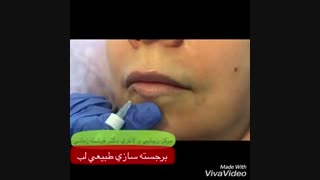 برجسته سازی طبیعی لب با تزیرق فیلر