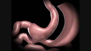 انیمیشن فیلم اسلیو گاسترکتومی