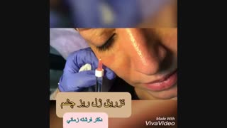 رفع گودی چشم با تزریق فیلر